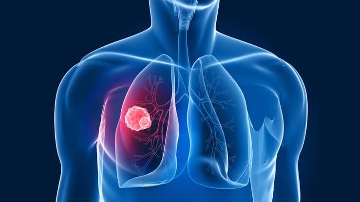 Kanker Paru-Paru